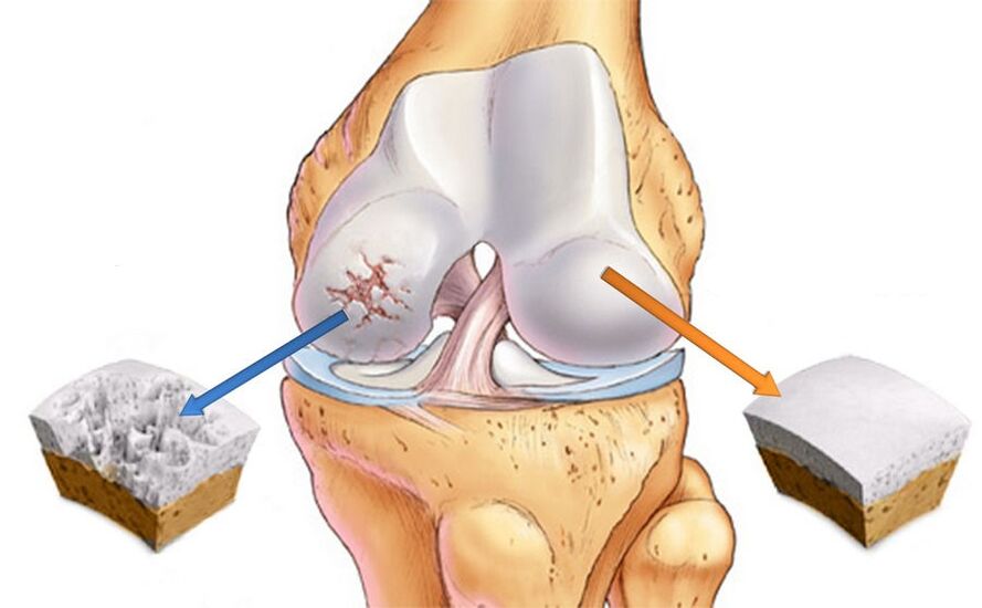 Arthrosis of the knee joint and healthy cartilage