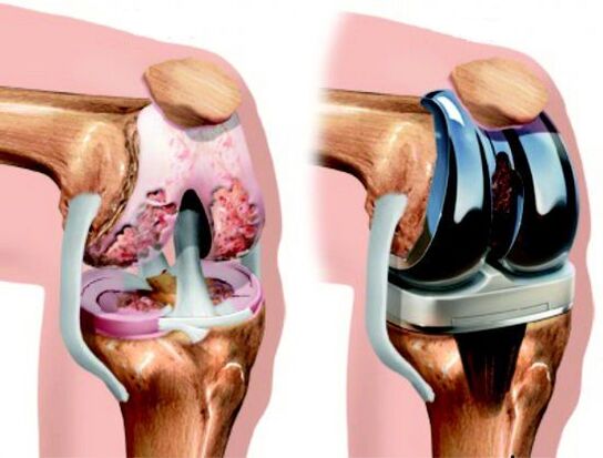 Result of arthritic knee replacement surgery