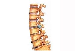 Stages of the development of cervical osteochondrosis