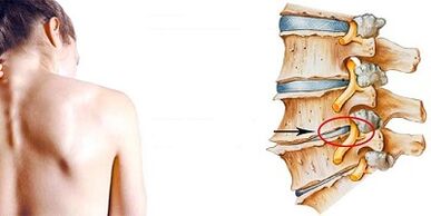 The mechanism of the development of osteochondrosis of the cervix