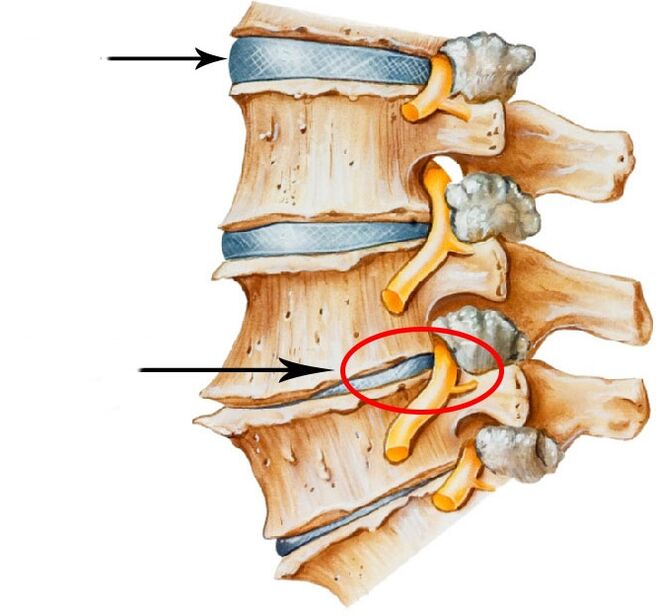 To develop a disk hernia