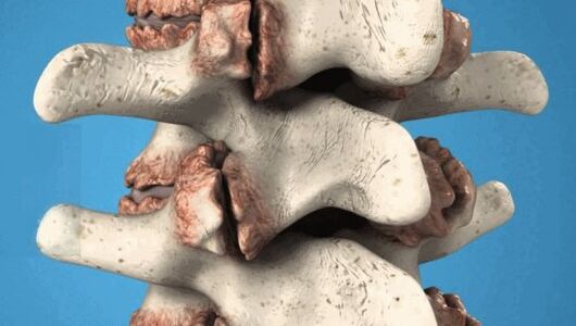 Osteophytes of vertebrae - pathological growth that damage nerves and blood vessels