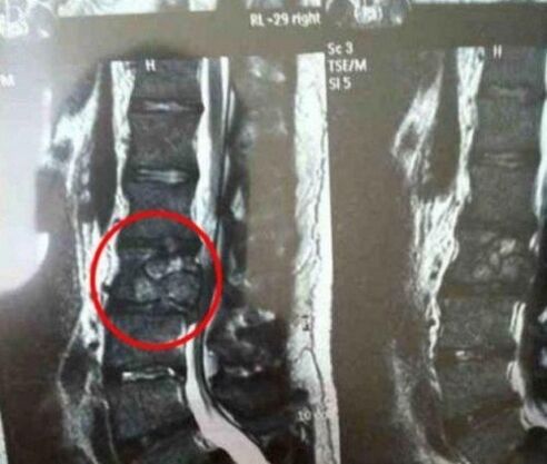 The spinal cancer in the picture