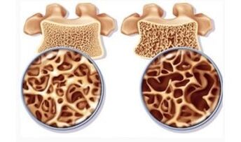 The risk of cervical suction for women