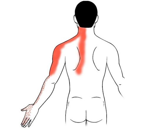 cervical osteochondrosis as the cause of joint pain in the fingers