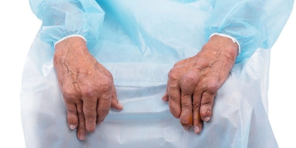 Infectious arthritis is a disease that causes constant pain and changes in the joints of the fingers.