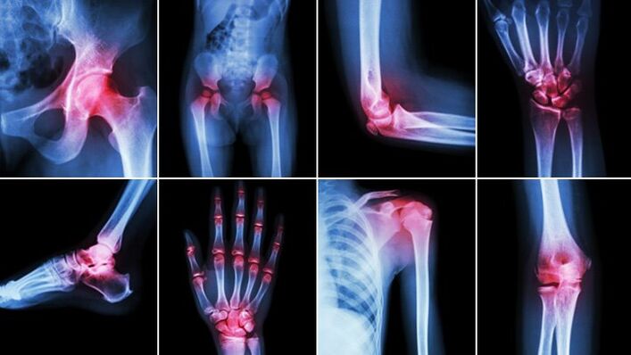 joints of the body affected by arthrosis